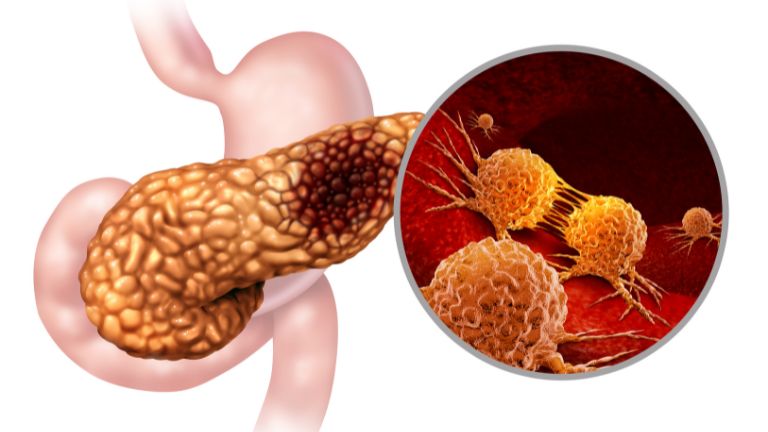 Nódulos pancreáticos - Imagem Ilustrativa